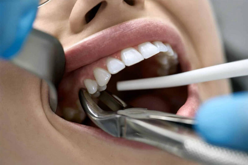 bezbolesne usuwanie zębów gliwice